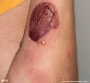 pemphigoid-bullous pemphigoid
