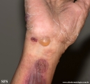 pemphigoid-bullous pemphigoid