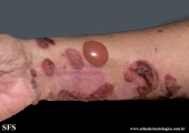 pemphigoid-bullous pemphigoid