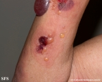 pemphigoid-bullous pemphigoid