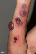 pemphigoid-bullous pemphigoid