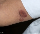 pemphigoid-bullous pemphigoid