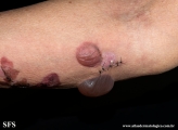 pemphigoid-bullous pemphigoid