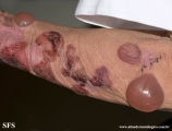 pemphigoid-bullous pemphigoid