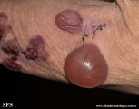 pemphigoid-bullous pemphigoid