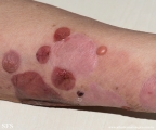 pemphigoid-bullous pemphigoid