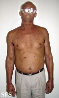 pemphigoid-bullous pemphigoid