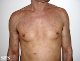 pemphigoid-bullous pemphigoid