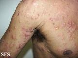 pemphigoid-bullous pemphigoid