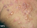 pemphigoid-bullous pemphigoid