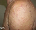 pemphigoid-bullous pemphigoid