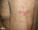 pemphigoid-bullous pemphigoid