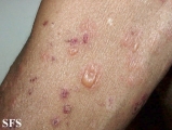 pemphigoid-bullous pemphigoid