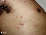 pemphigoid-bullous pemphigoid