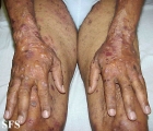 pemphigoid-bullous pemphigoid