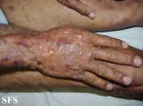 pemphigoid-bullous pemphigoid