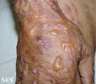 pemphigoid-bullous pemphigoid