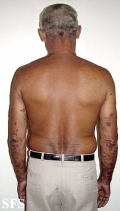pemphigoid-bullous pemphigoid