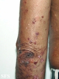 pemphigoid-bullous pemphigoid