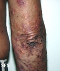 pemphigoid-bullous pemphigoid