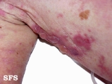 pemphigoid-bullous pemphigoid