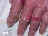 pemphigoid-bullous pemphigoid