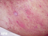 pemphigoid-bullous pemphigoid