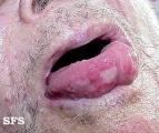 pemphigoid-bullous pemphigoid