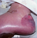pemphigoid-bullous pemphigoid