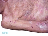 pemphigoid-bullous pemphigoid