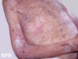 pemphigoid-bullous pemphigoid
