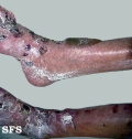 pemphigoid-bullous pemphigoid