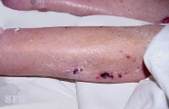 pemphigoid-bullous pemphigoid