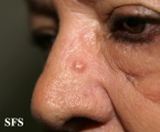 fibrofolliculoma