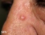 fibrofolliculoma
