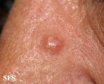 fibrofolliculoma