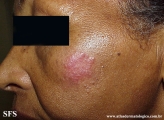 sarcoidosis