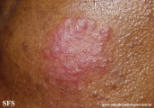 sarcoidosis