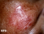 sarcoidosis