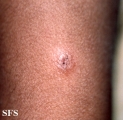 sarcoidosis