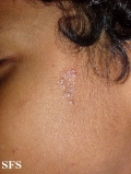 sarcoidosis