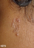 sarcoidosis