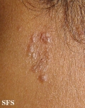 sarcoidosis