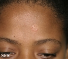 sarcoidosis