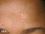 sarcoidosis