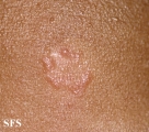 sarcoidosis