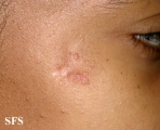 sarcoidosis