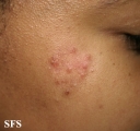sarcoidosis