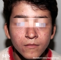 sarcoidosis