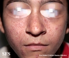 sarcoidosis